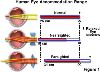 a látás helyreállítása egy gyertyán a 4 látás rossz