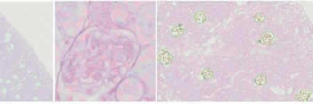Trois images d’échantillons sur lame montrant des glomérules et des noyaux rénaux marqués et comptés par TruAI
