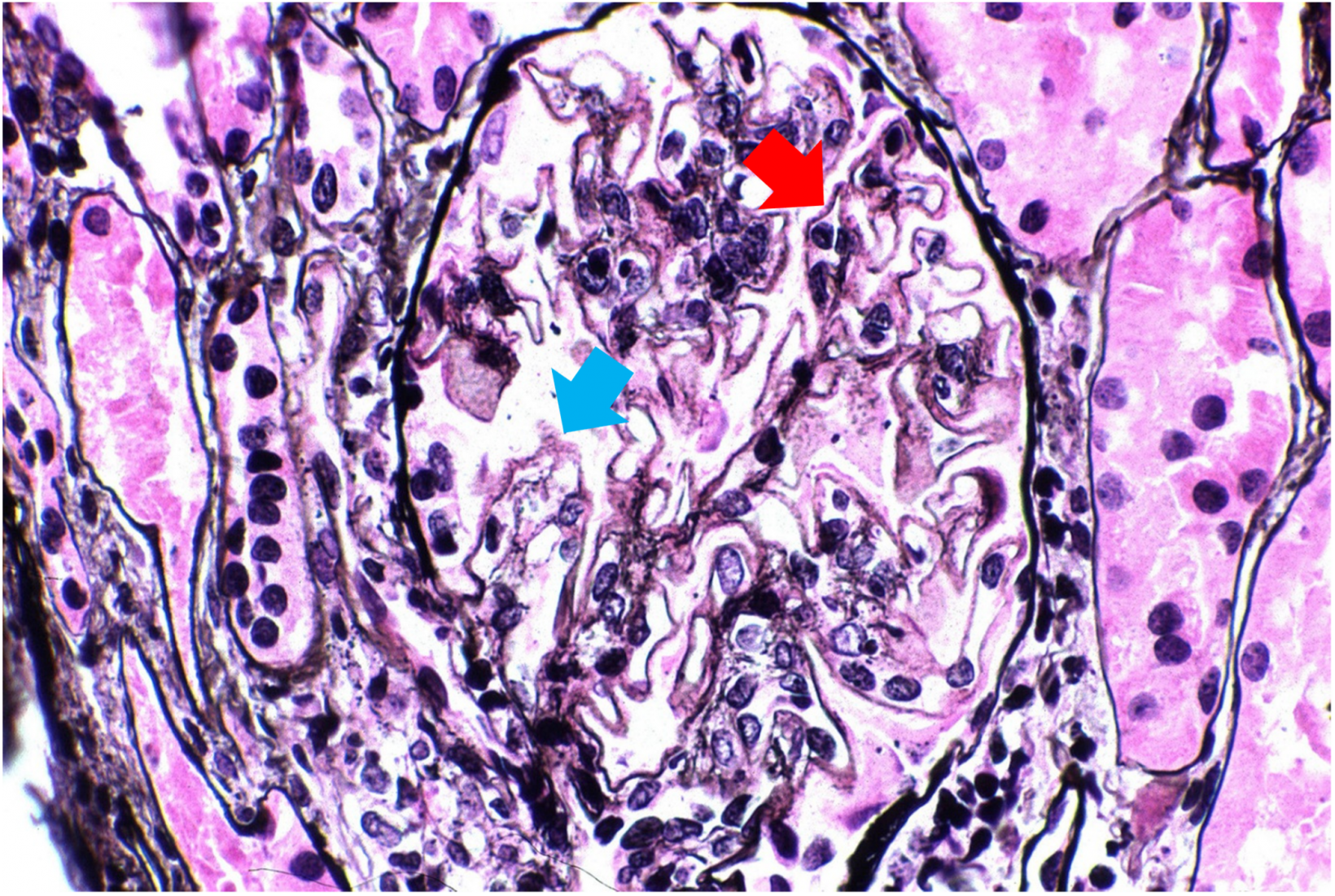 ループス腎炎クラス5患者の腎臓スライドサンプルの拡大画像